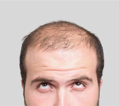 فیناستراید ریزش مو