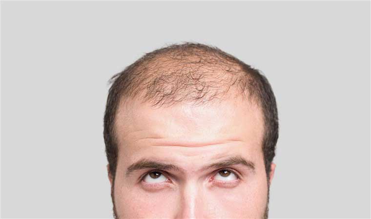 فیناستراید ریزش مو
